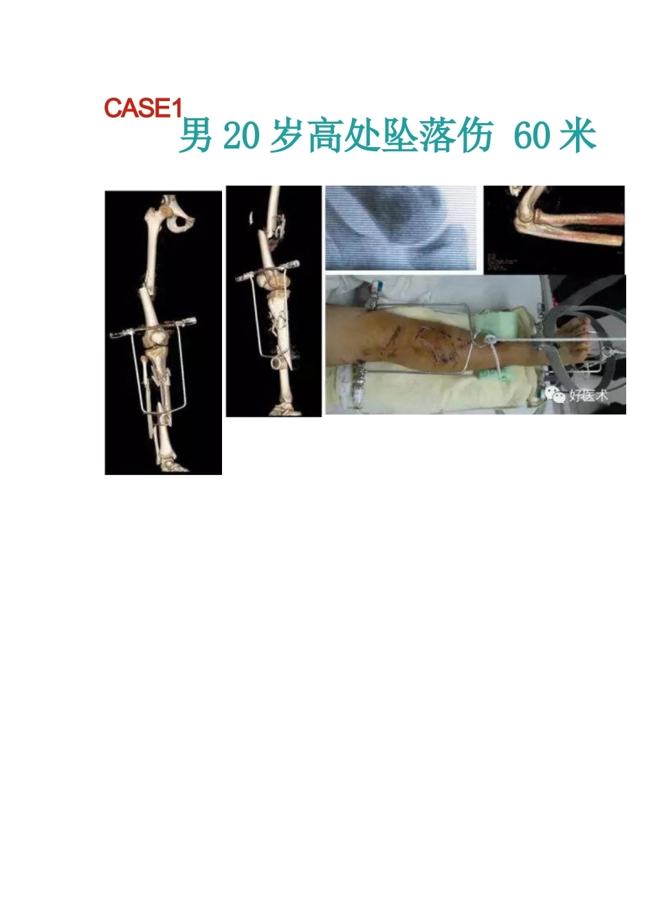 髓内钉治疗胫 骨近端骨折技术_第15页