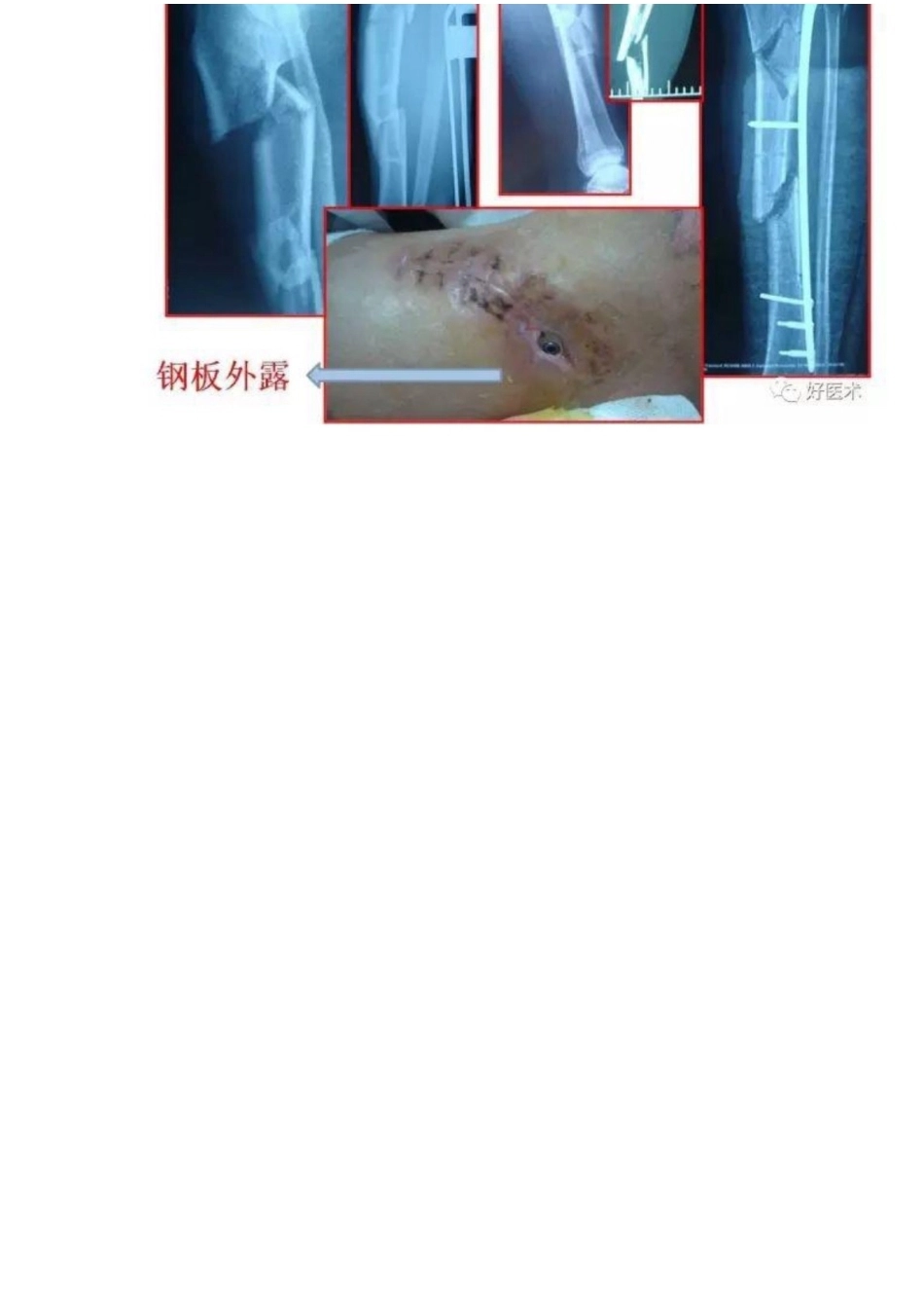 髓内钉治疗胫 骨近端骨折技术_第7页