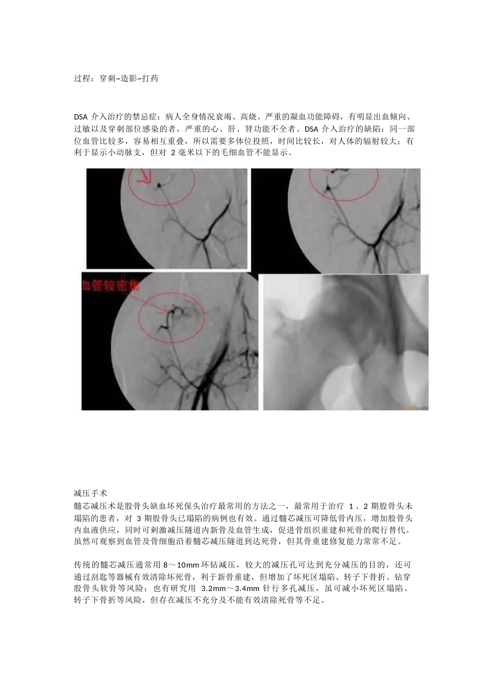 股骨头坏死的诊 断与治疗策略_第10页