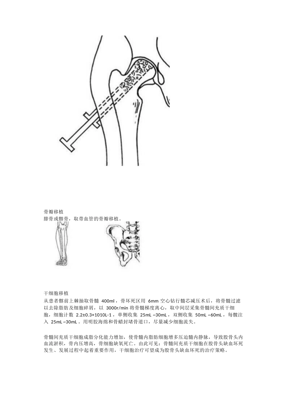 股骨头坏死的诊 断与治疗策略_第11页