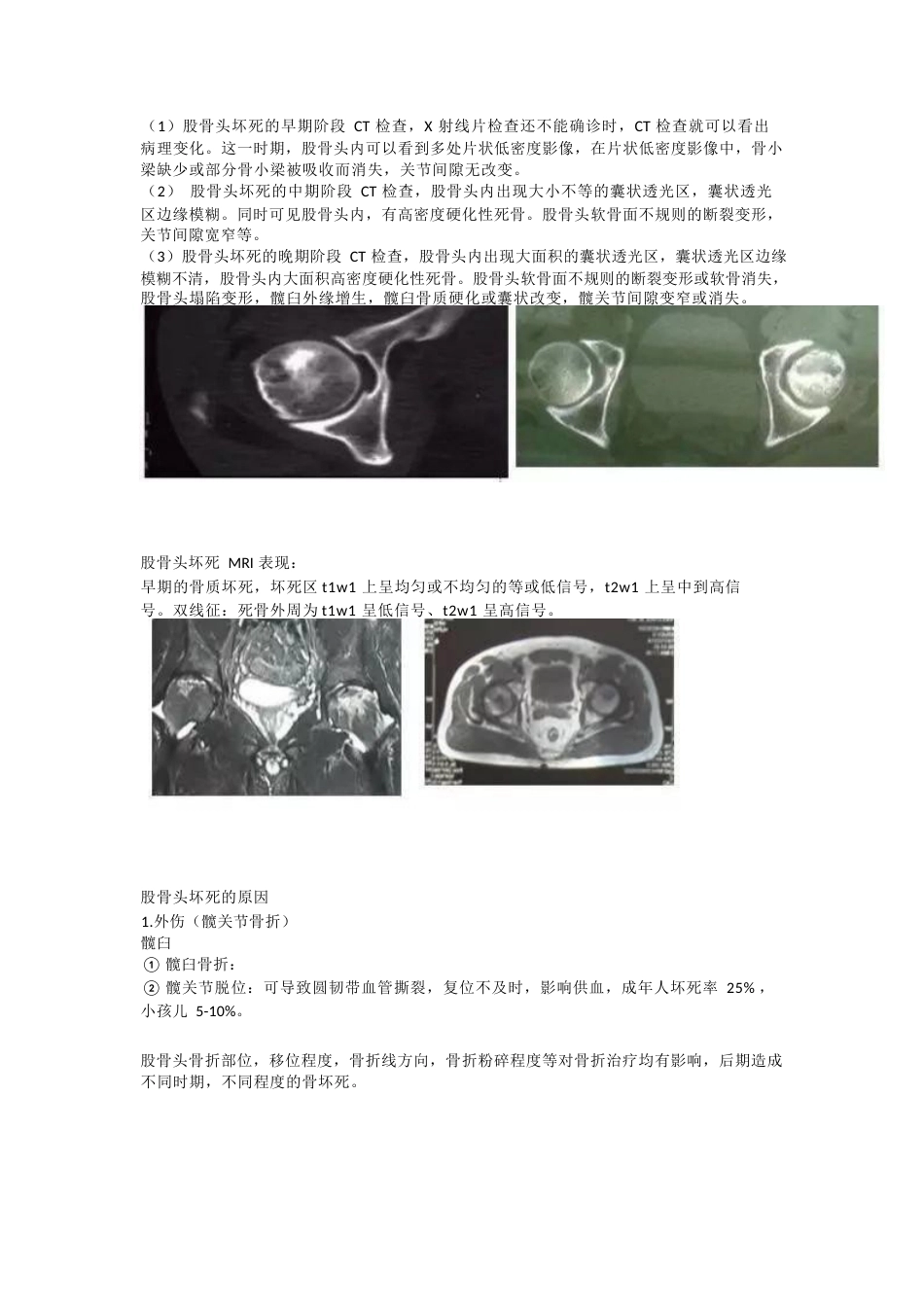 股骨头坏死的诊 断与治疗策略_第6页