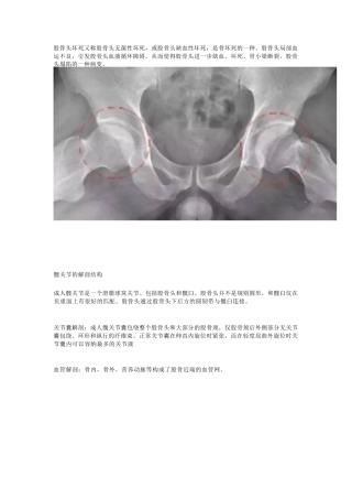 股骨头坏死的诊 断与治疗策略