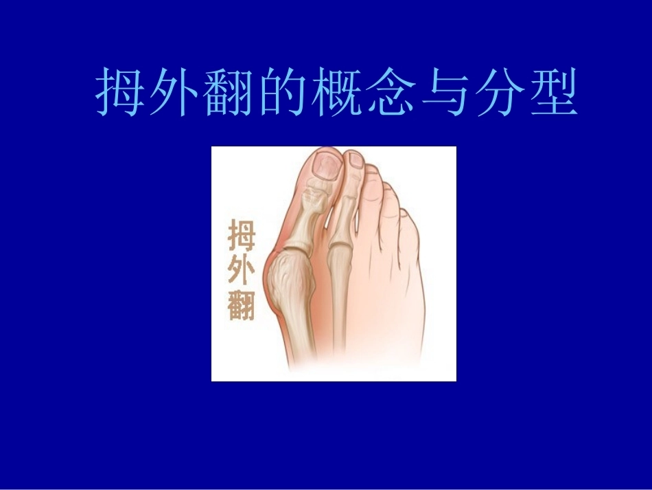 拇外翻的概念与分型_第1页