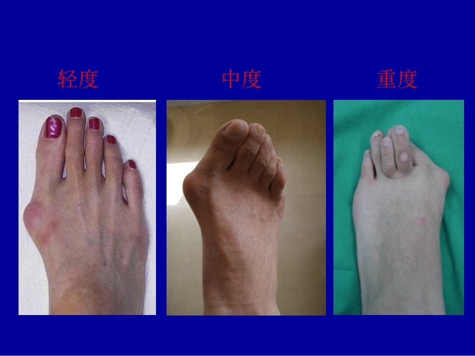 拇外翻的概念与分型_第10页