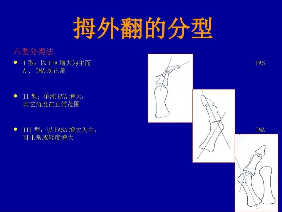 拇外翻的概念与分型_第11页