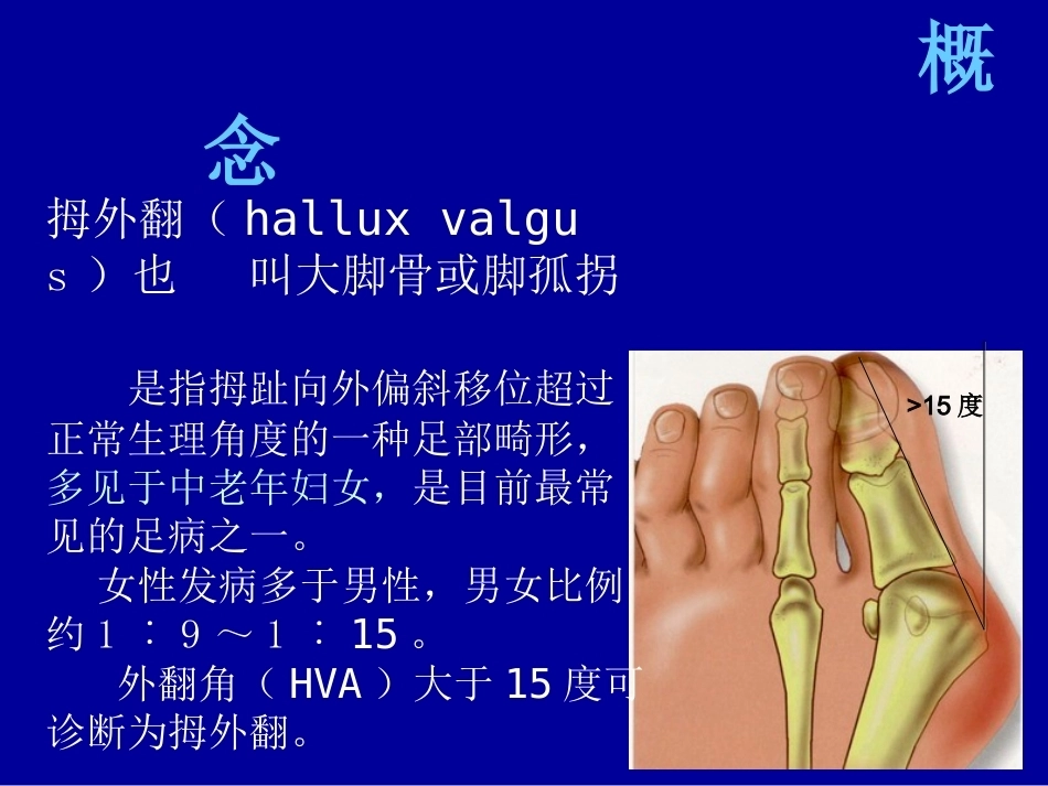 拇外翻的概念与分型_第2页