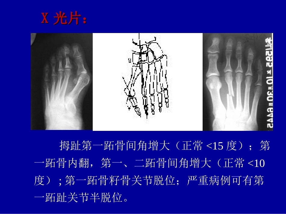 拇外翻的概念与分型_第4页
