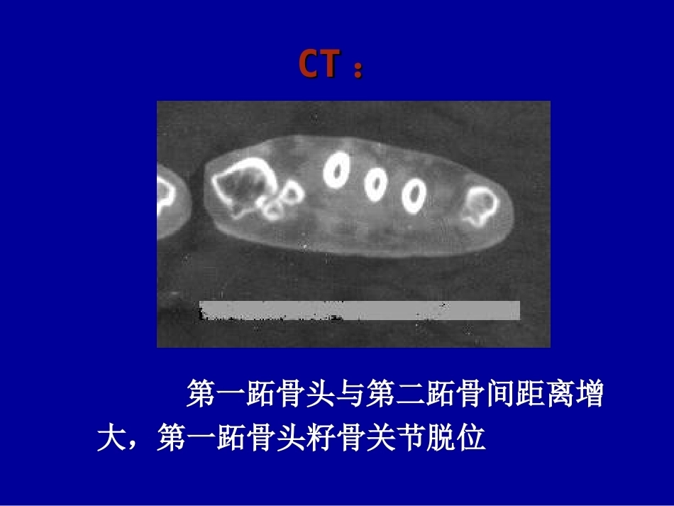 拇外翻的概念与分型_第5页