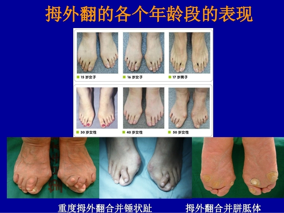 拇外翻的概念与分型_第7页