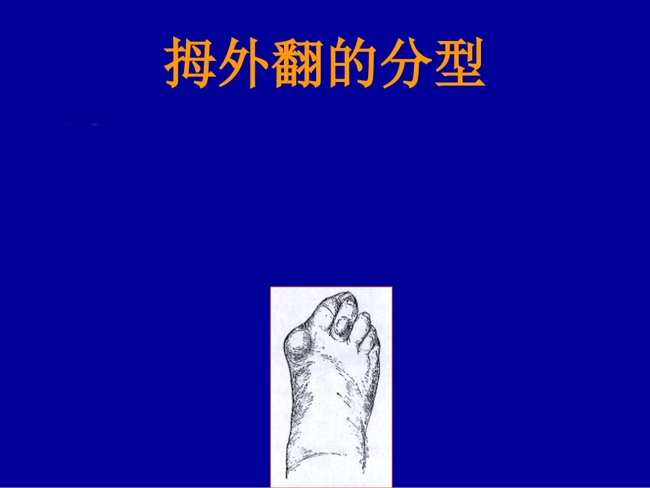 拇外翻的概念与分型_第8页