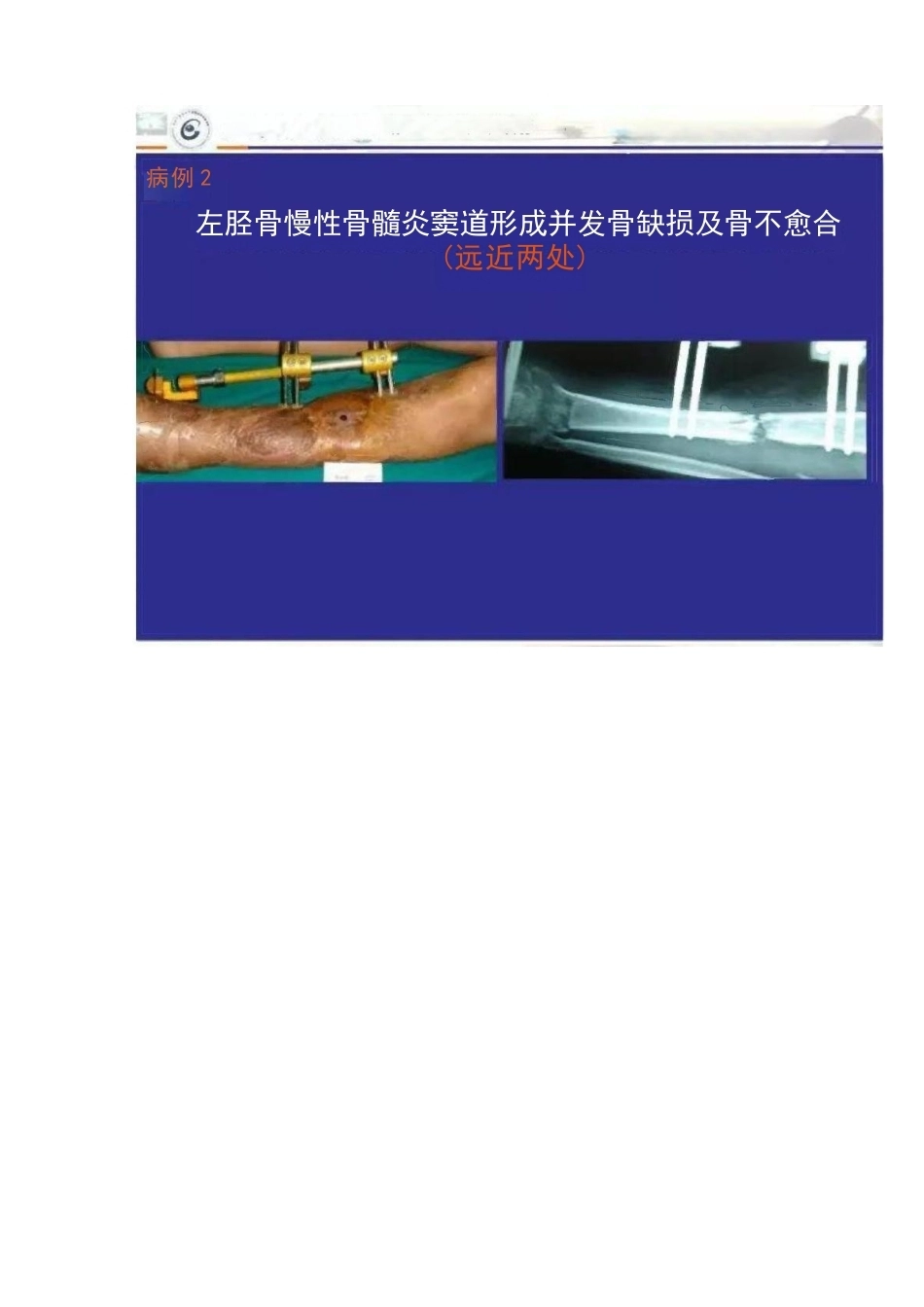 显微技术 治疗骨髓炎骨缺损_第13页
