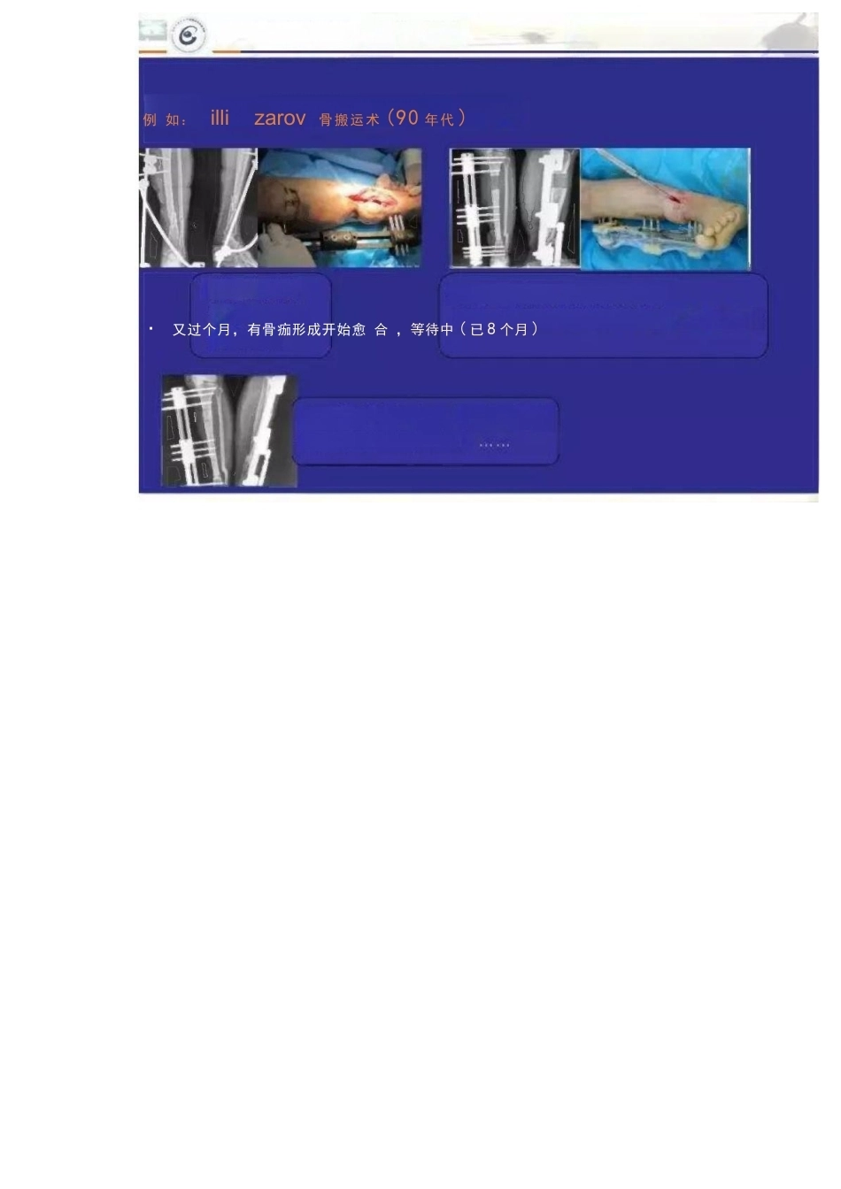 显微技术 治疗骨髓炎骨缺损_第3页