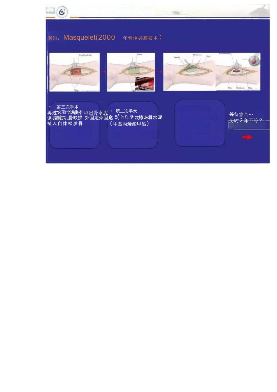 显微技术 治疗骨髓炎骨缺损_第4页