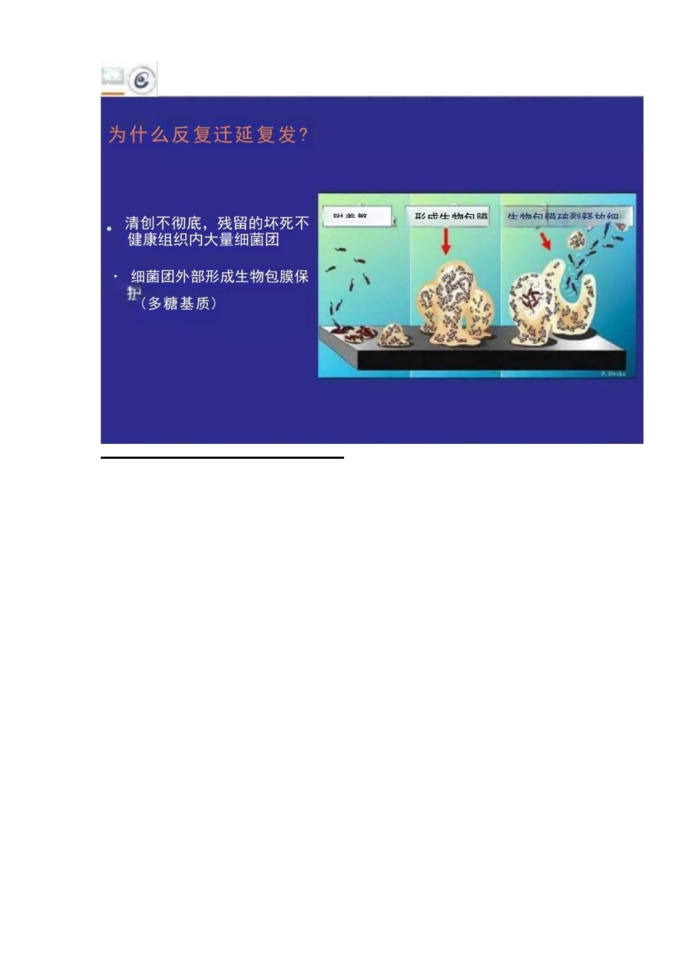 显微技术 治疗骨髓炎骨缺损_第5页