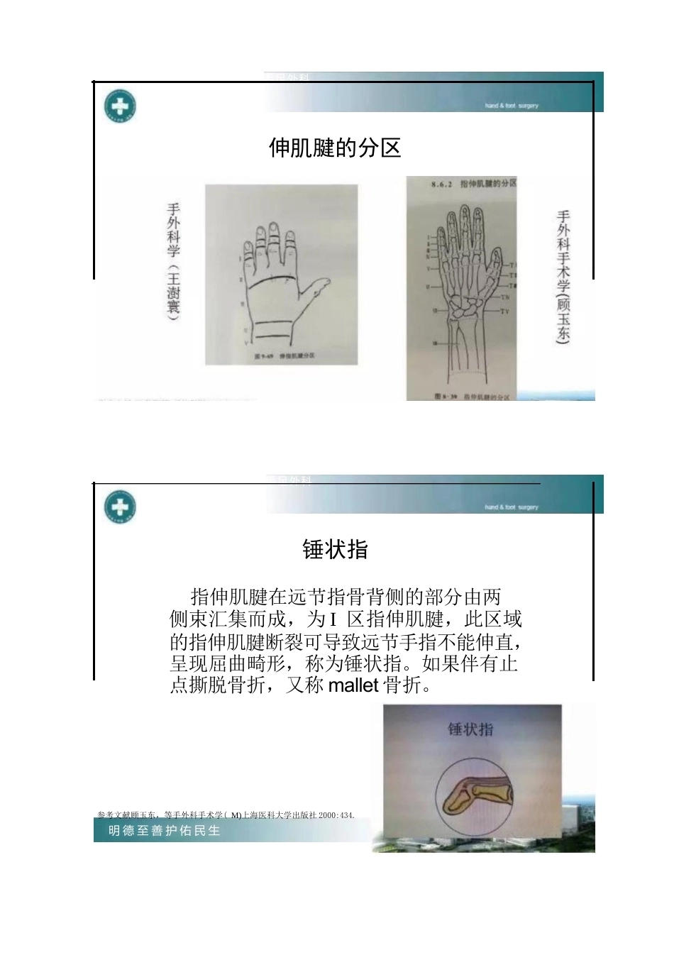 锤状指的分型及手术治疗_第1页