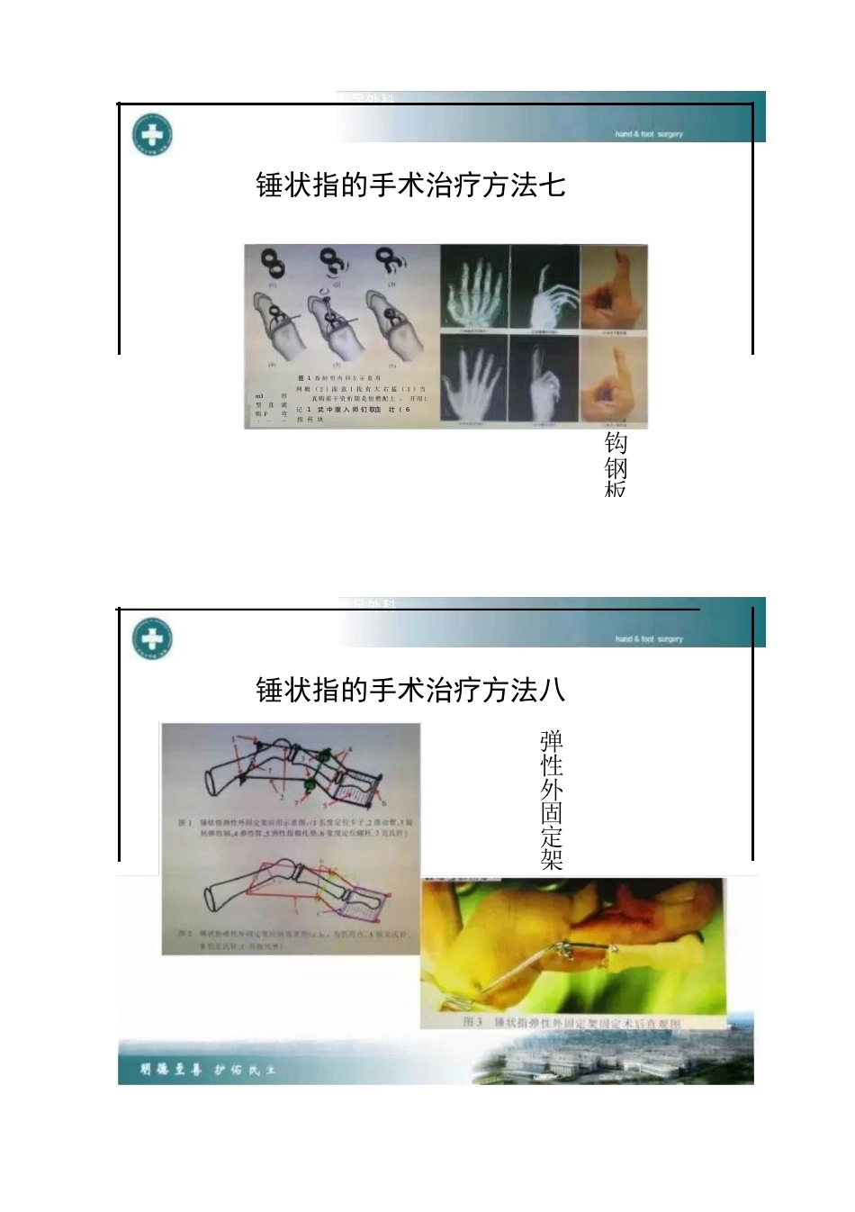 锤状指的分型及手术治疗_第10页