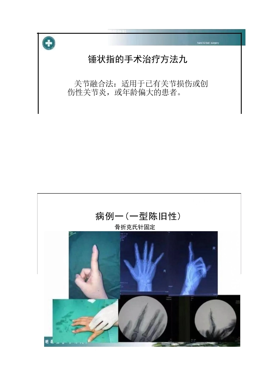 锤状指的分型及手术治疗_第11页