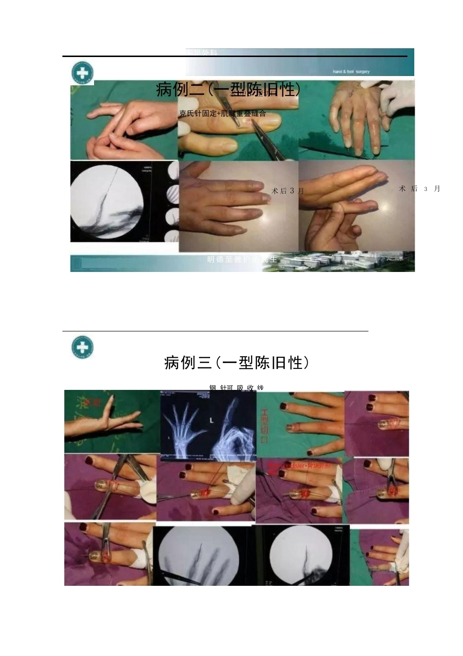 锤状指的分型及手术治疗_第12页