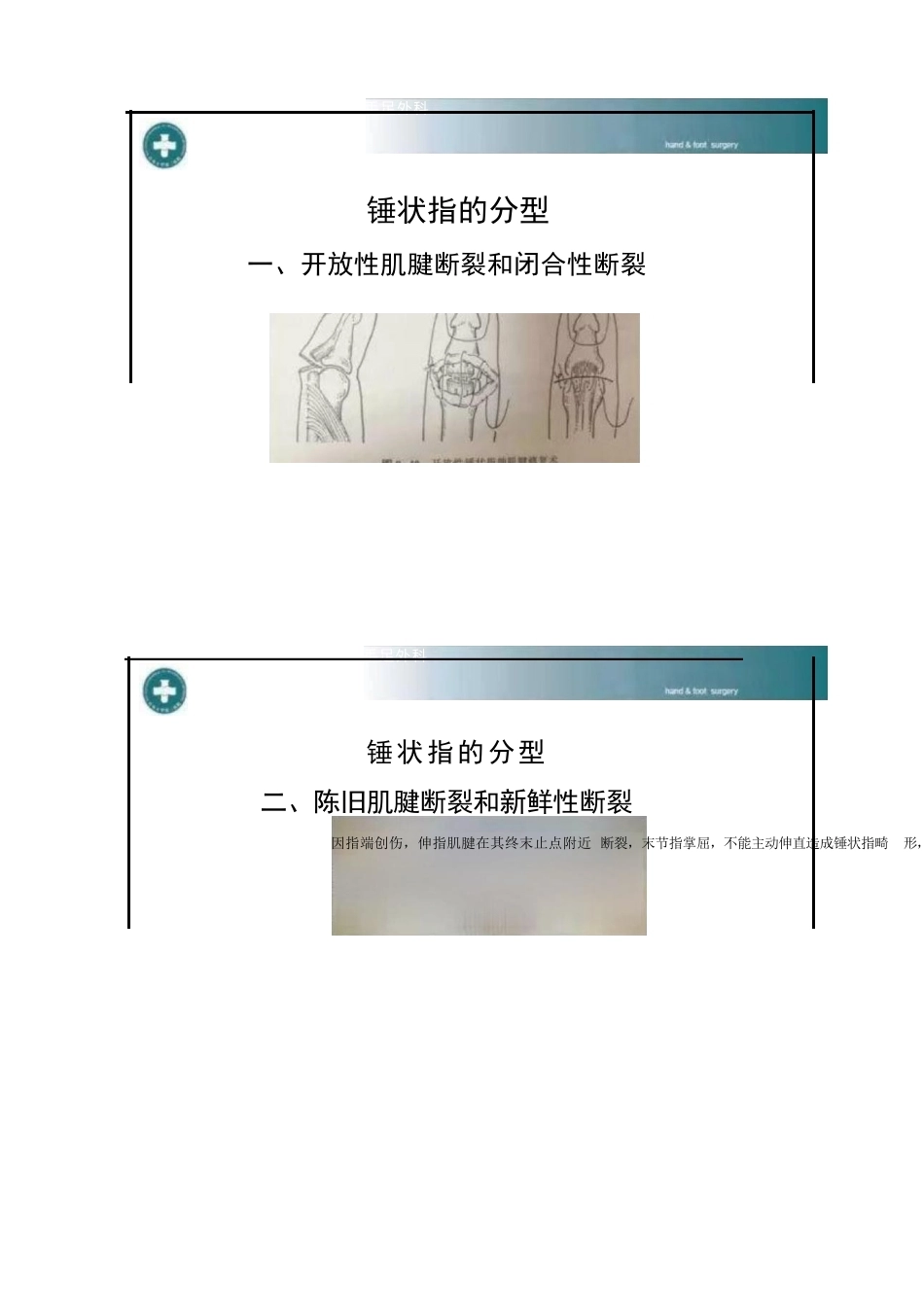 锤状指的分型及手术治疗_第2页