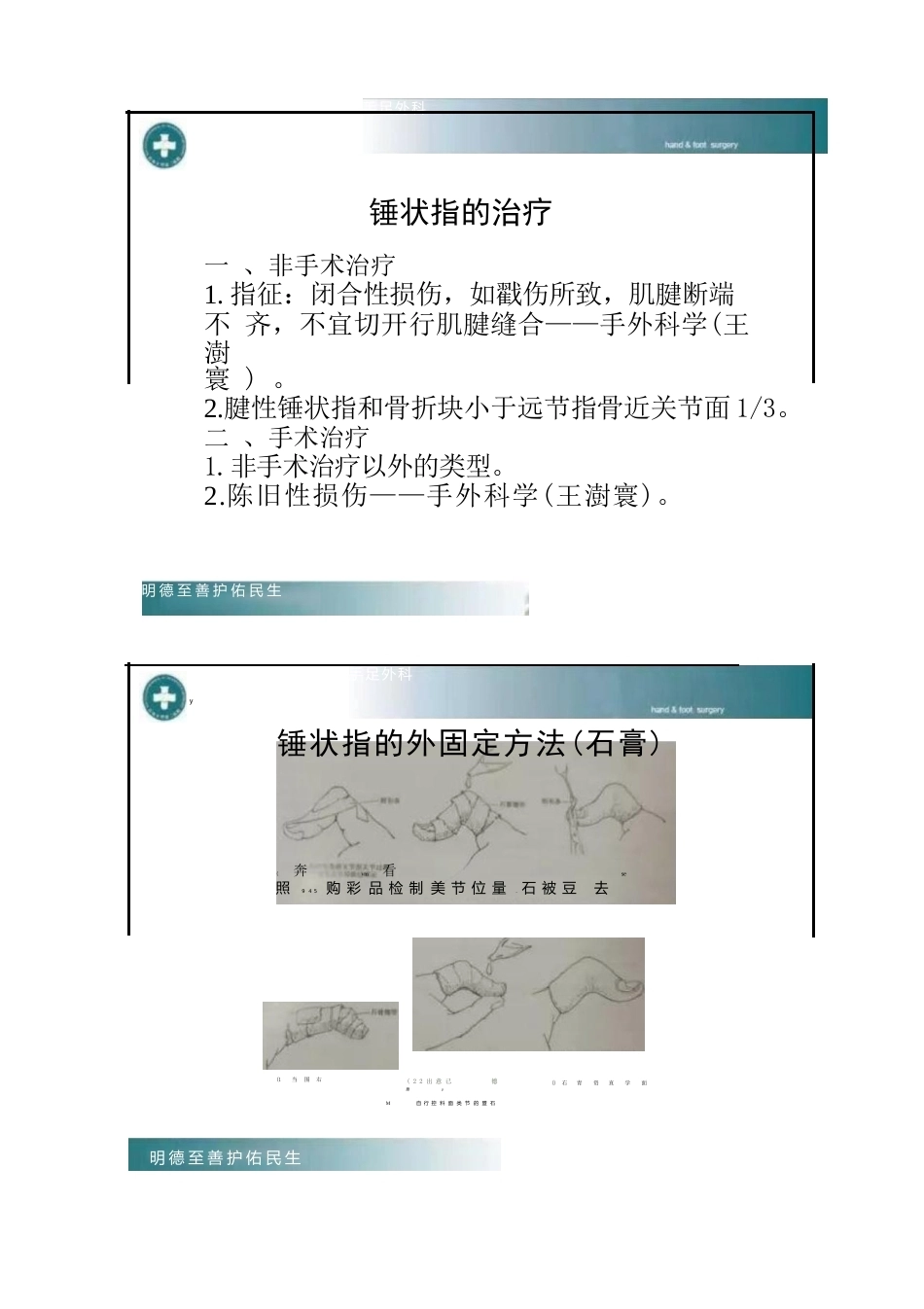 锤状指的分型及手术治疗_第4页
