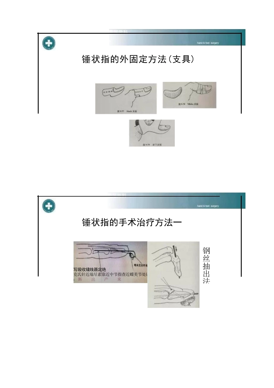 锤状指的分型及手术治疗_第5页