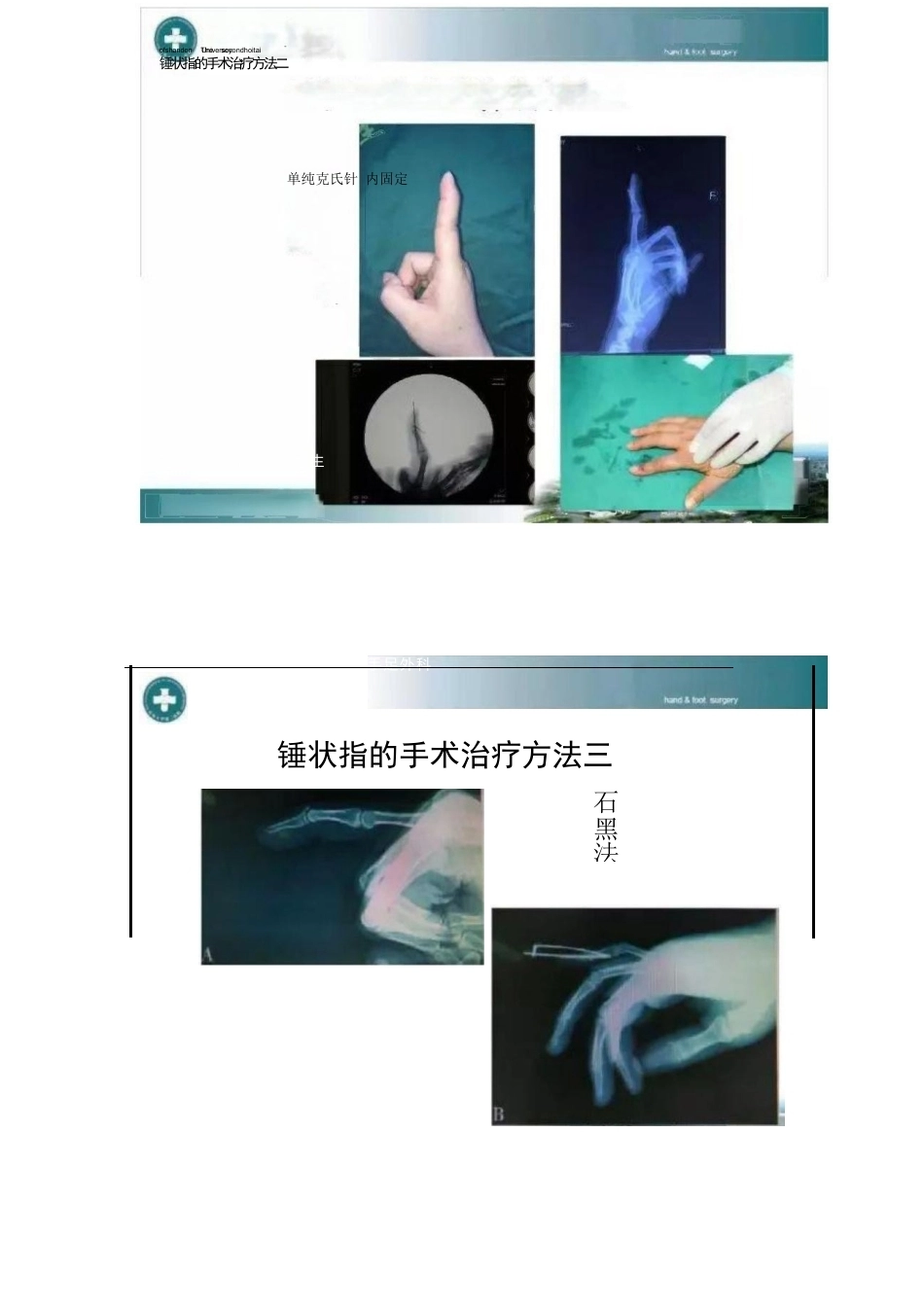锤状指的分型及手术治疗_第6页