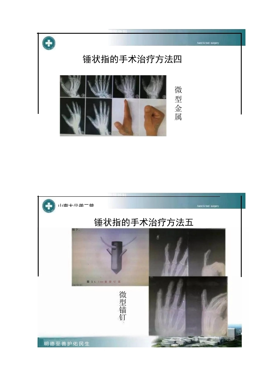 锤状指的分型及手术治疗_第7页