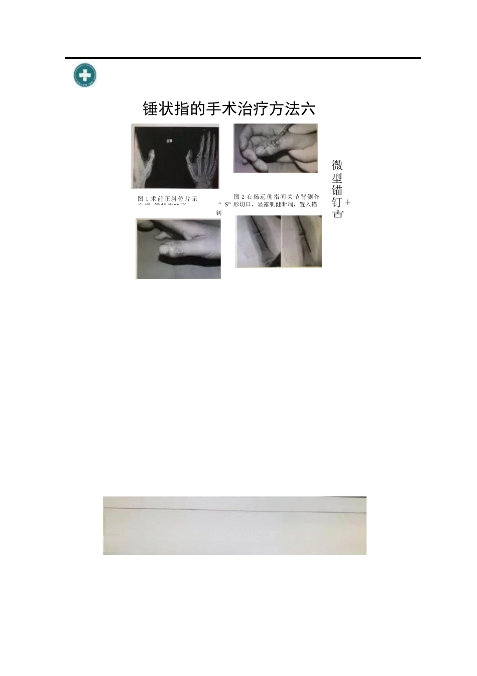 锤状指的分型及手术治疗_第8页