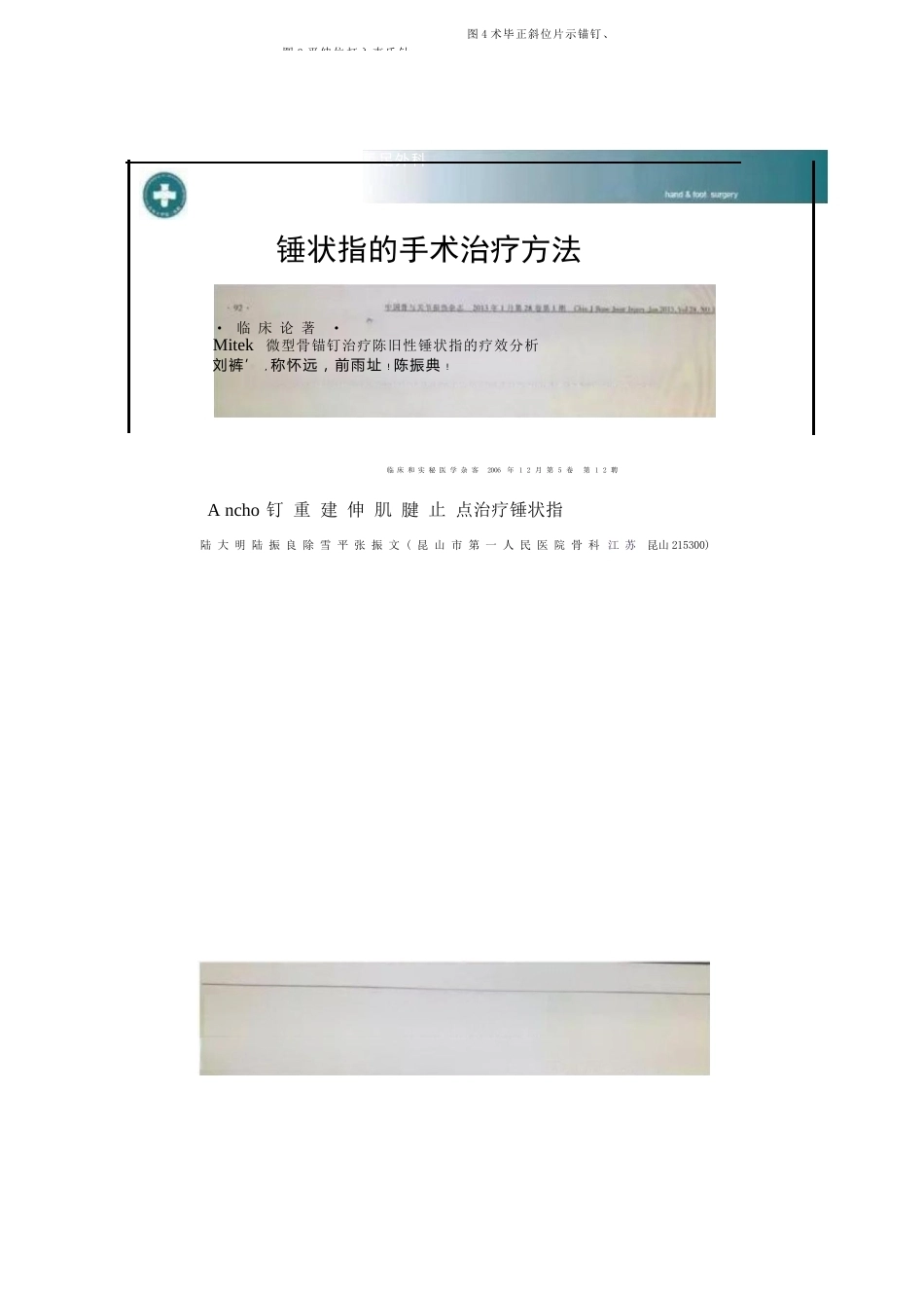 锤状指的分型及手术治疗_第9页