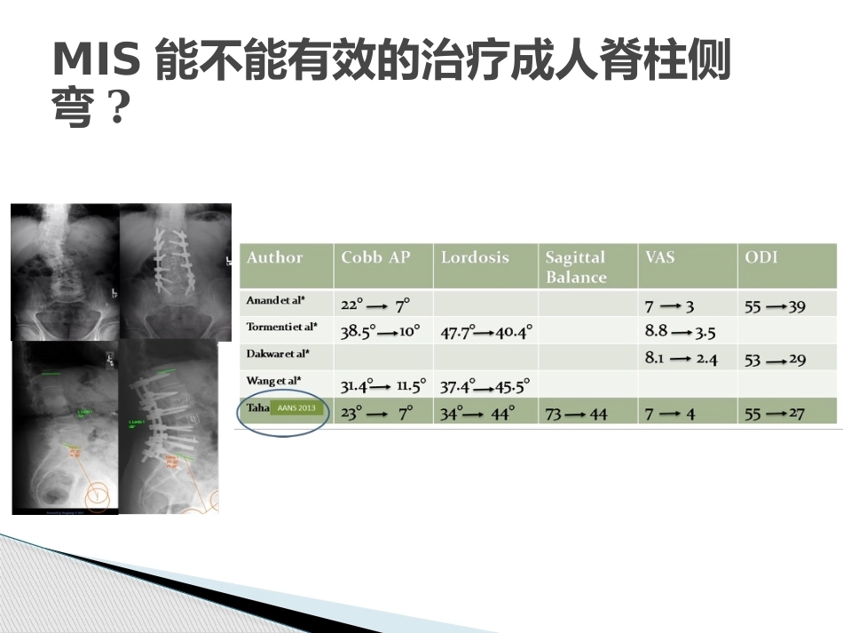 MISS治疗成人退变性脊 柱侧弯_第13页