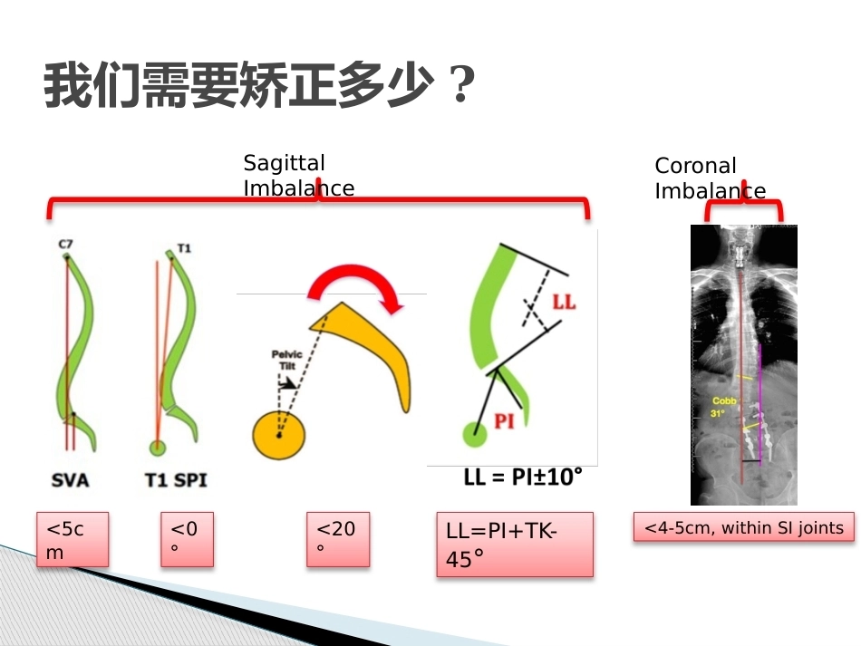 MISS治疗成人退变性脊 柱侧弯_第6页