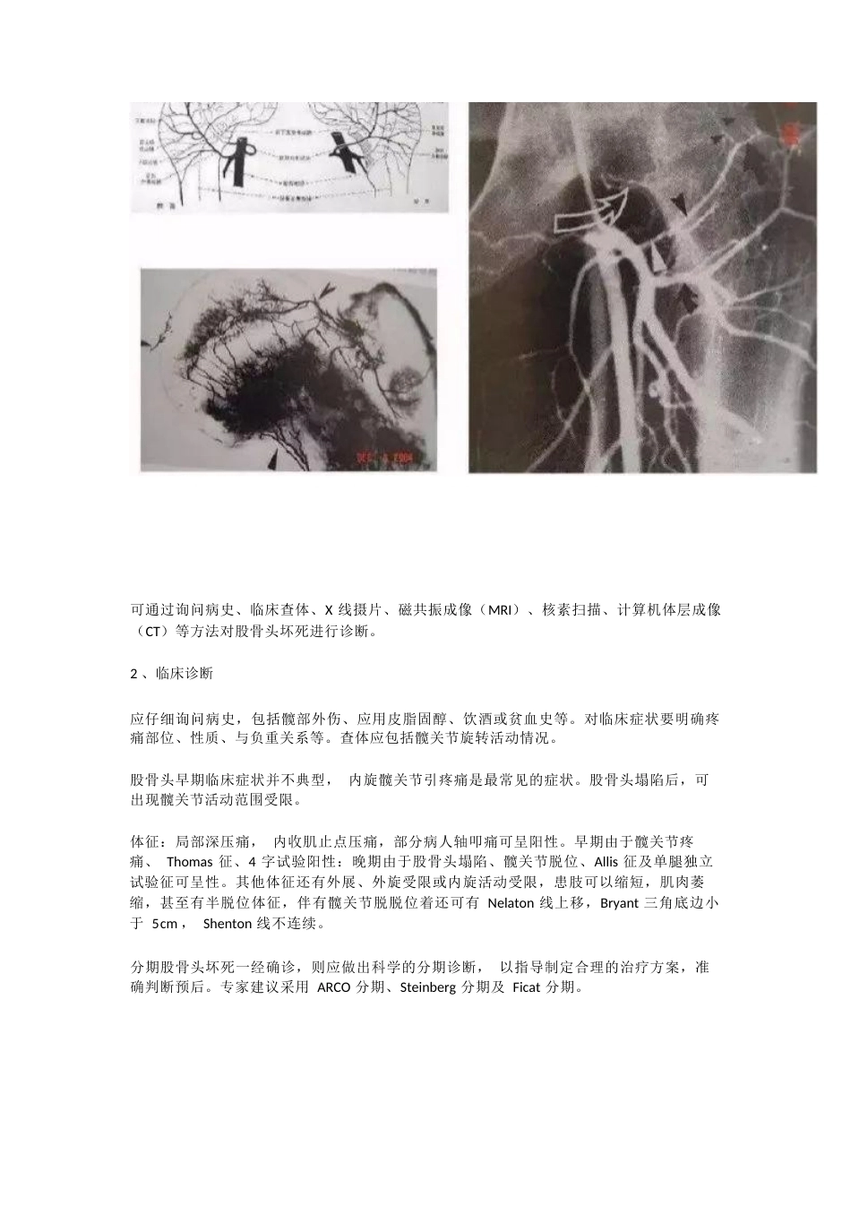 股骨头坏死的分型治疗_第2页
