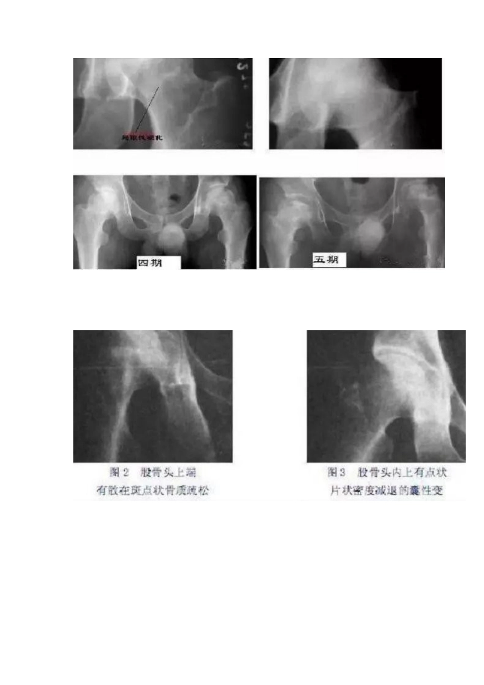 股骨头坏死的分型治疗_第5页