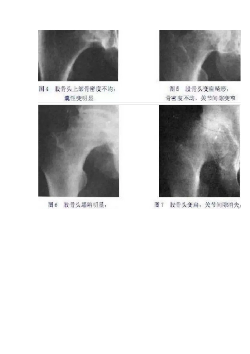 股骨头坏死的分型治疗_第6页