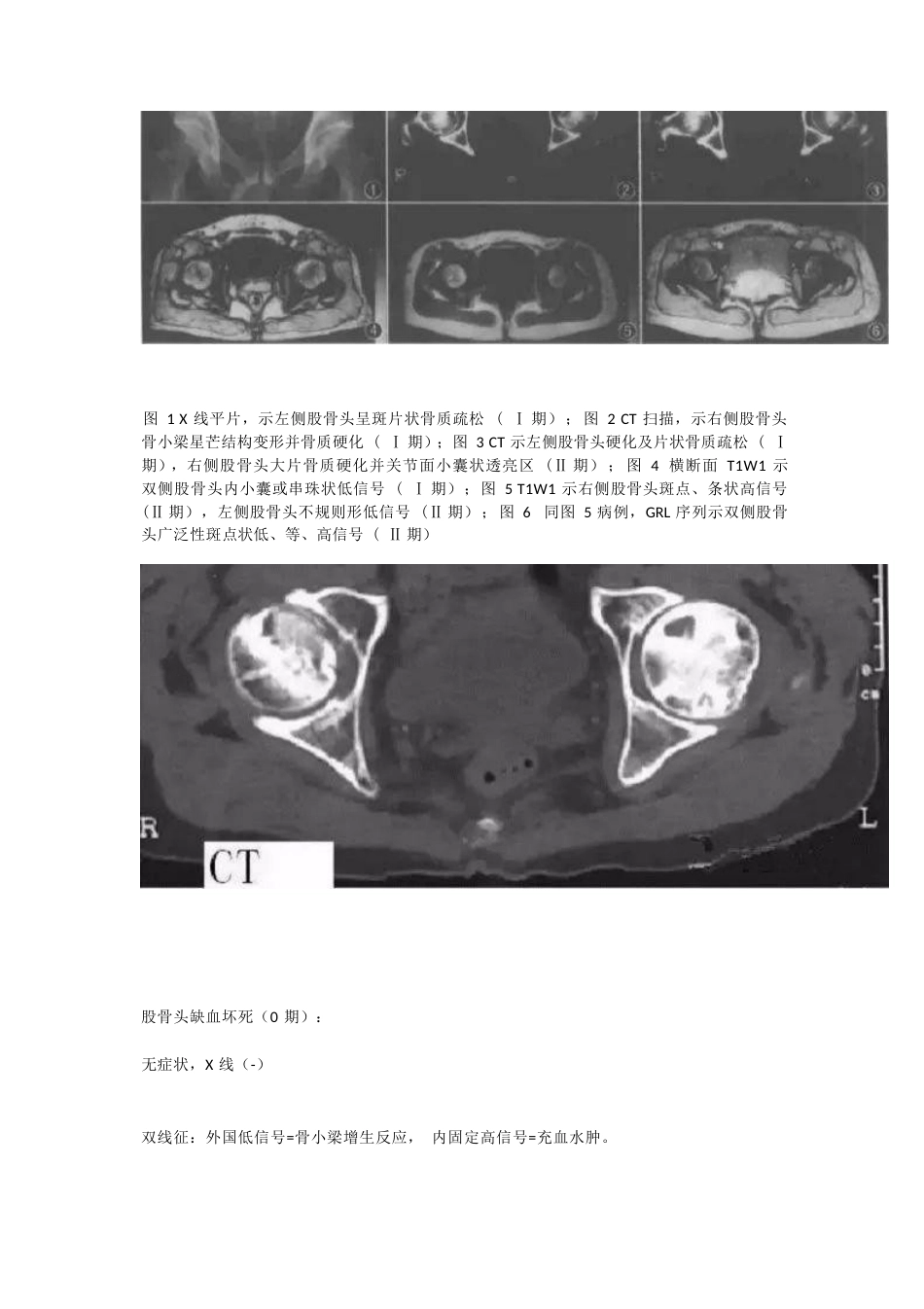 股骨头坏死的分型治疗_第7页