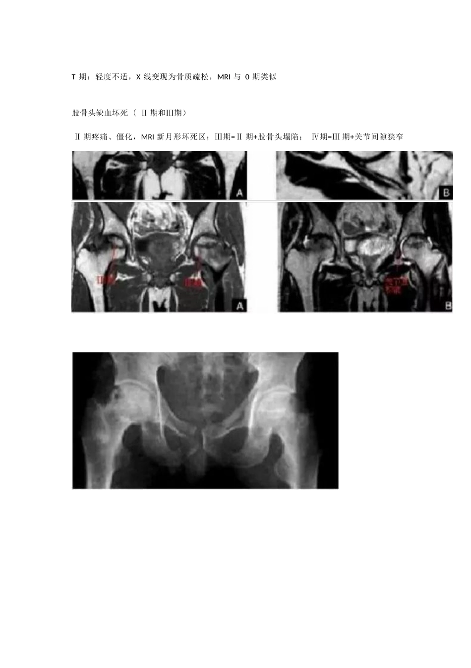 股骨头坏死的分型治疗_第8页