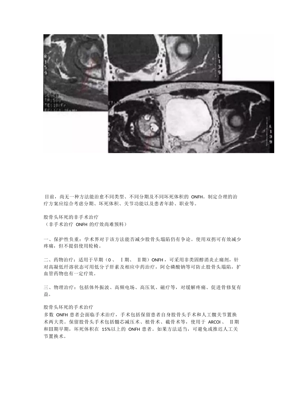 股骨头坏死的分型治疗_第9页