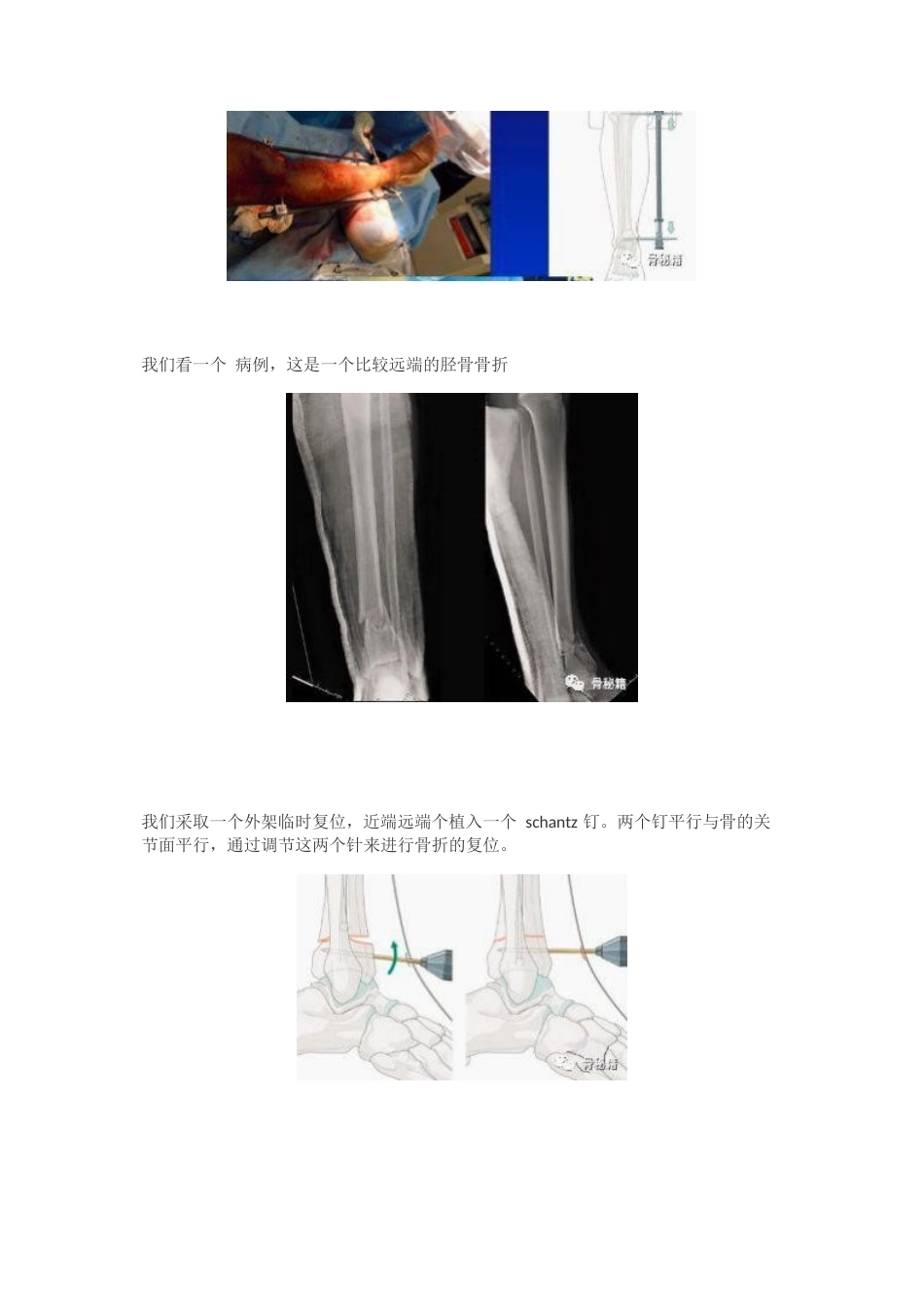 胫骨远端骨折髓内钉固定 技巧_第4页