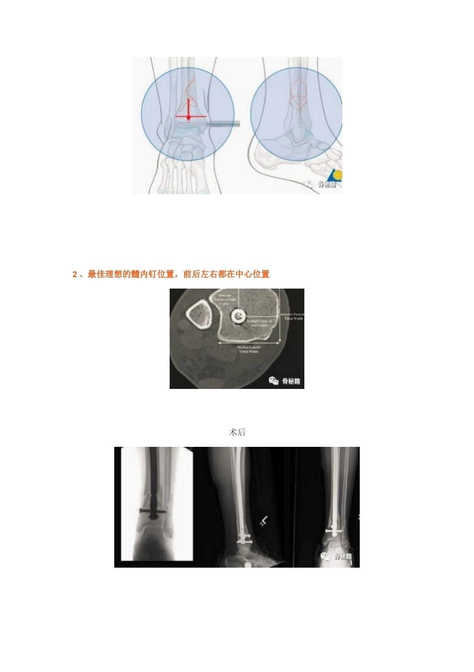 胫骨远端骨折髓内钉固定 技巧_第6页