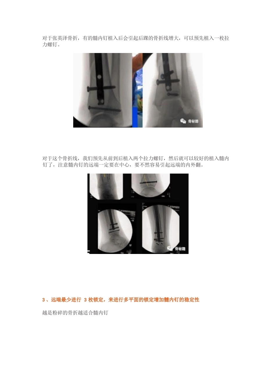 胫骨远端骨折髓内钉固定 技巧_第7页