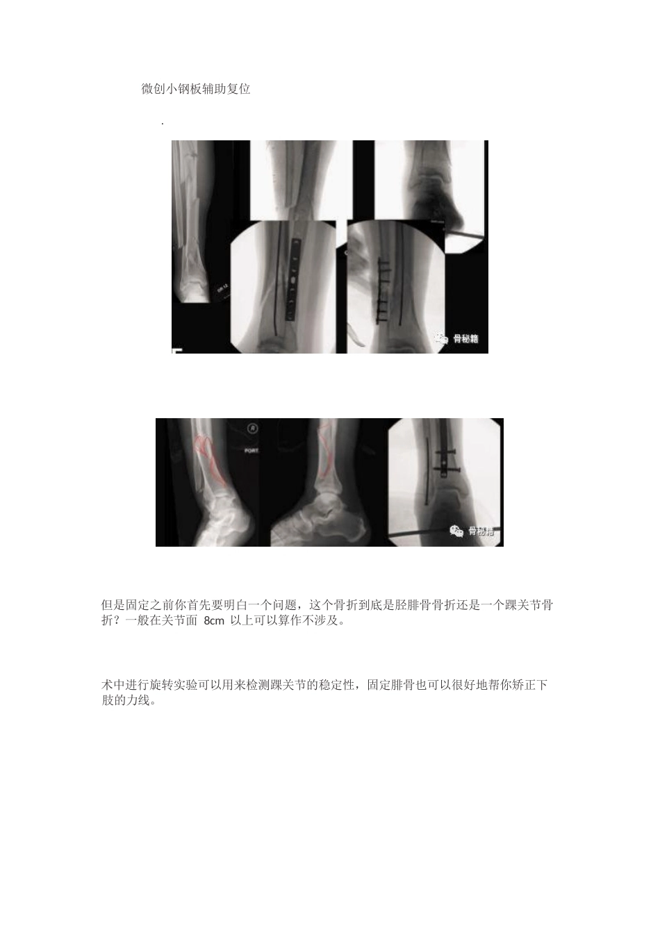 胫骨远端骨折髓内钉固定 技巧_第9页