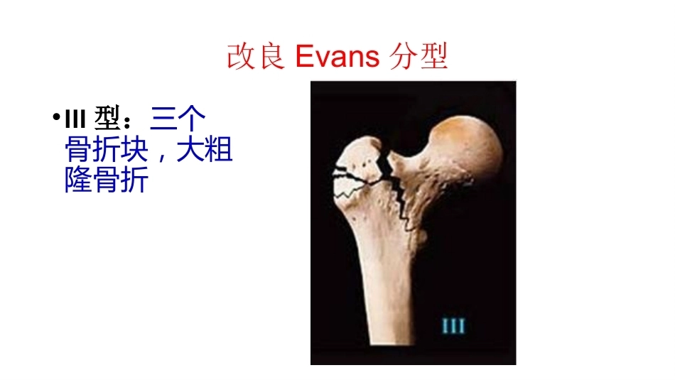 股骨粗隆间分型_第11页