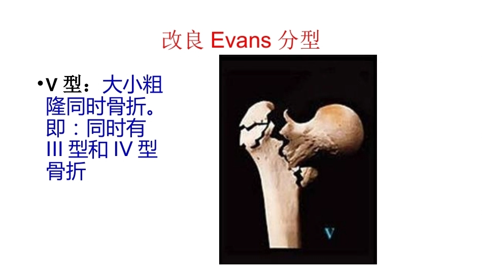 股骨粗隆间分型_第13页