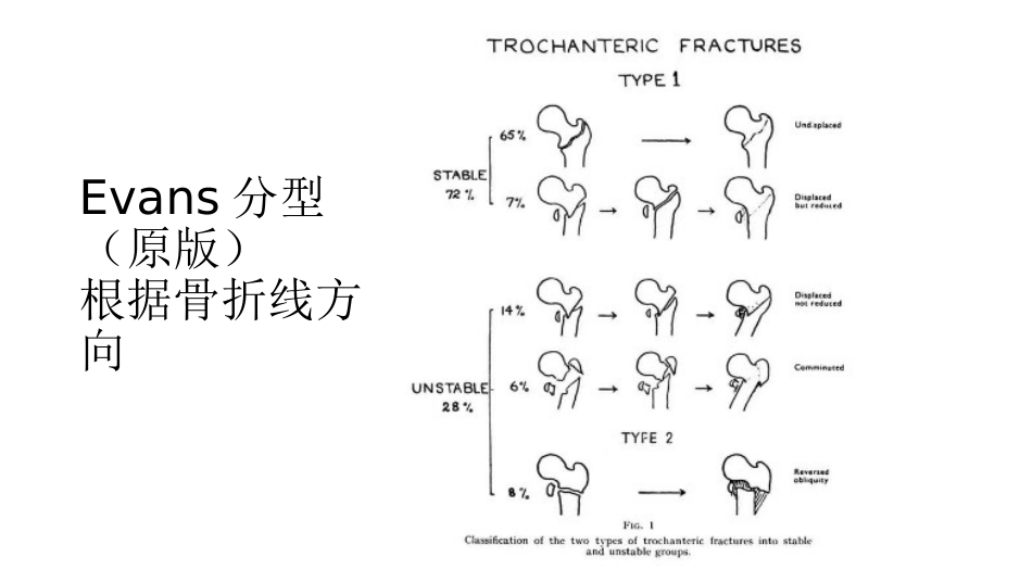 股骨粗隆间分型_第5页