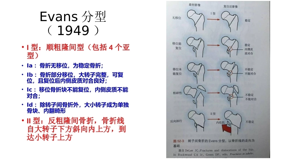 股骨粗隆间分型_第6页