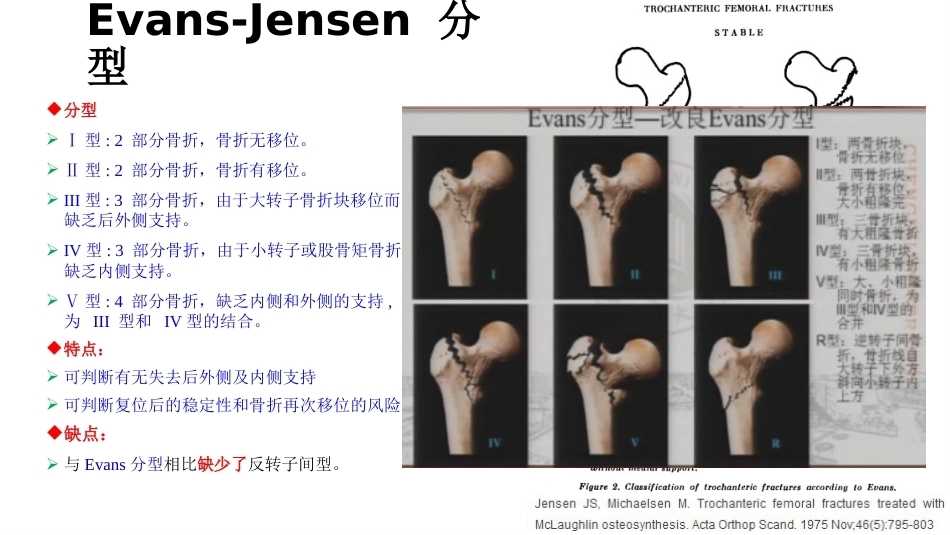 股骨粗隆间分型_第8页