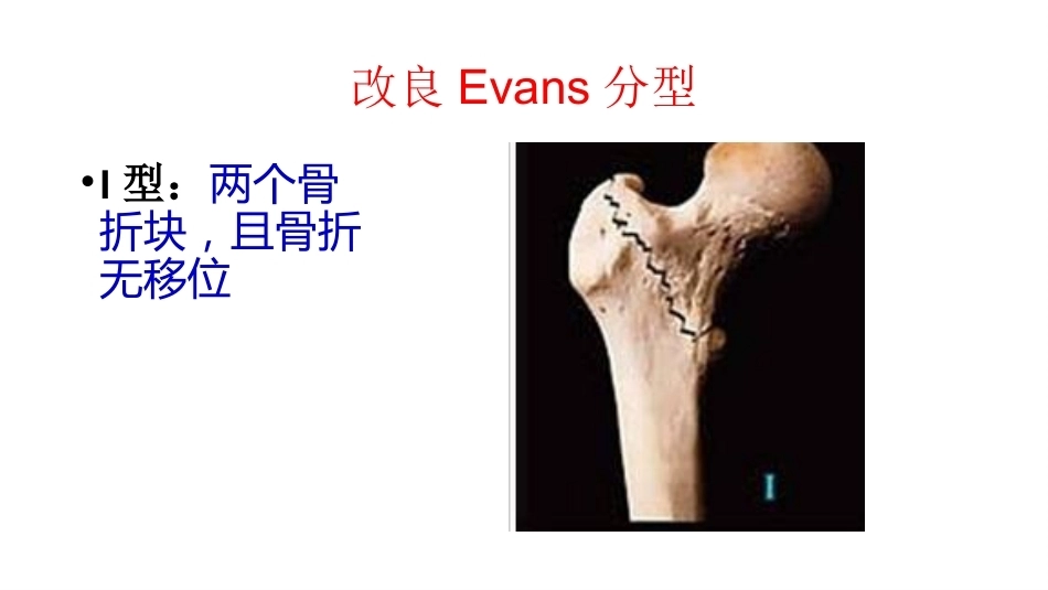 股骨粗隆间分型_第9页