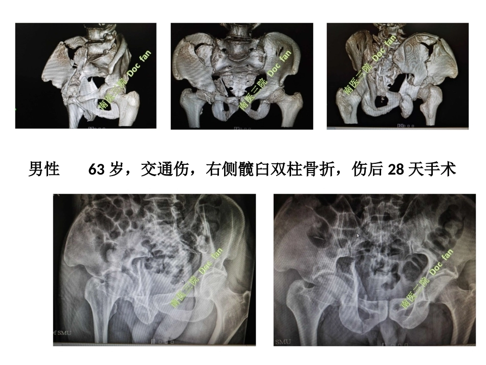 个性化设计私人定制髋臼螺旋桨钢板治疗组合图_第2页