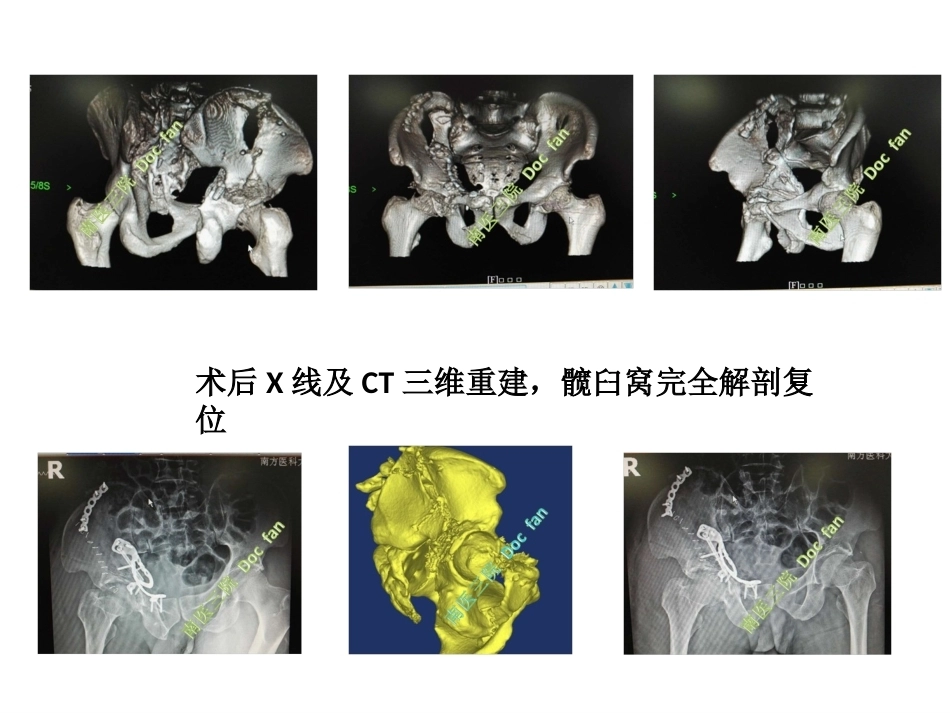 个性化设计私人定制髋臼螺旋桨钢板治疗组合图_第4页