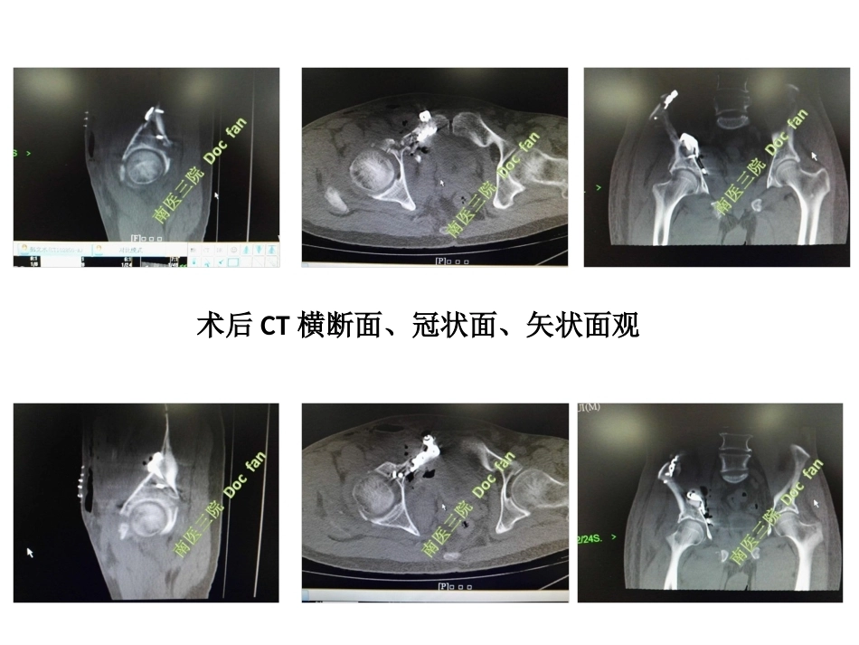 个性化设计私人定制髋臼螺旋桨钢板治疗组合图_第5页